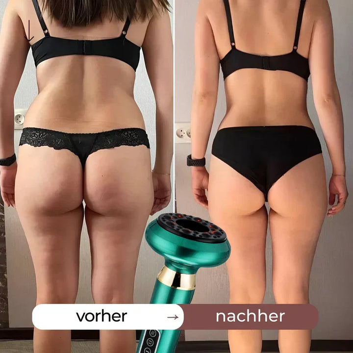 Cellulite-Massagegerät für Damen, zur Hautstraffung und Reduzierung von Dehnungsstreifen.