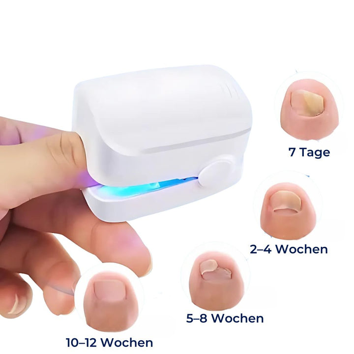 "Nagelpilz-Lasergerät für schmerzfreie Anwendung, Nahaufnahme, modernes Design, fördert gesunde Nagelregeneration."