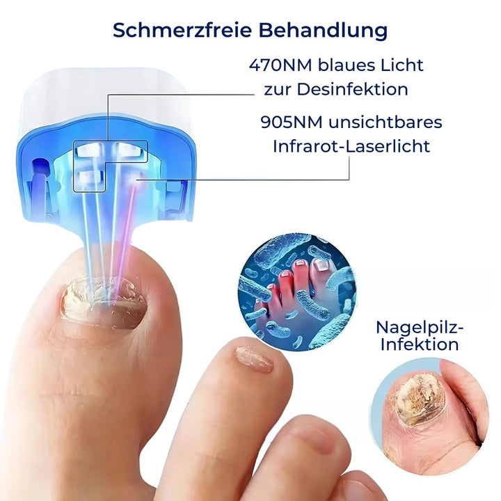 "Nagelpilz-Lasergerät für schmerzfreie Anwendung, Nahaufnahme, modernes Design, fördert gesunde Nagelregeneration."